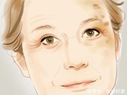 激光|困扰大多数人的色斑,到底用什么办法才能去除?