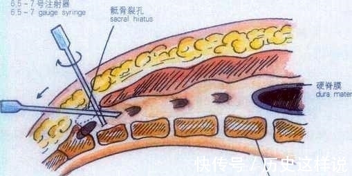包皮 包皮切除手术,怎么麻醉?