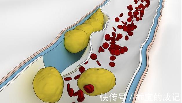 血液粘稠|高血脂的罪魁祸首找到了，不是肥肉，医生：饭后2件事早就该改掉