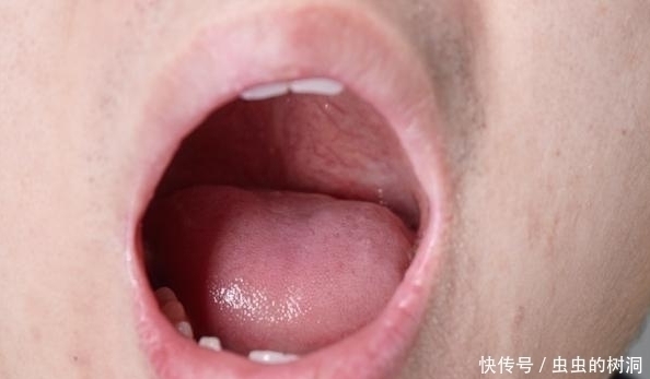 口腔溃疡|口腔溃疡不单是因为上火?反反复复发作另有原因,你真正了解吗?