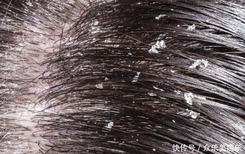 头皮|头皮头屑多还经常掉发教你这4招,头屑刷刷掉头发又浓密