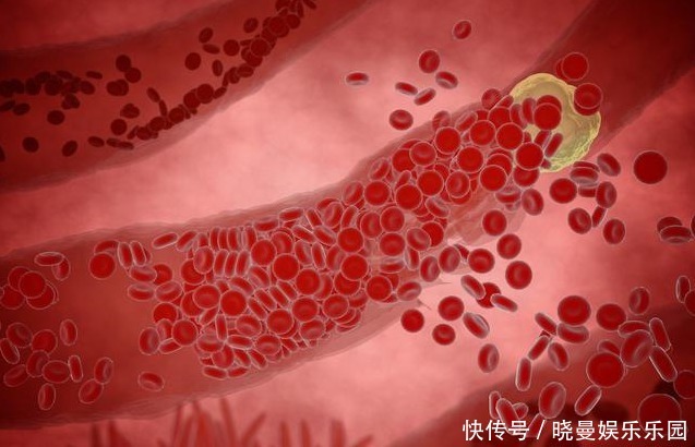 糖尿病患者|血脂高不高，看头就懂，若没有出现这3大症状，你就知足吧