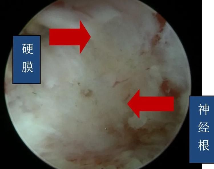 刘大姐|7mm的钥匙孔手术，解决颈椎病大难题