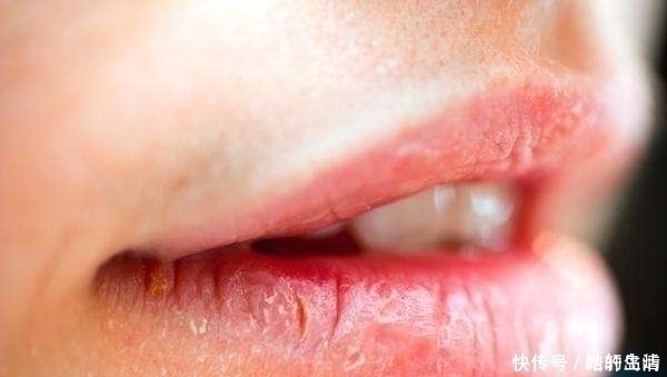 白带异常|女人是否有妇科病,看嘴就知道,健康的女性一般没有这4个异常