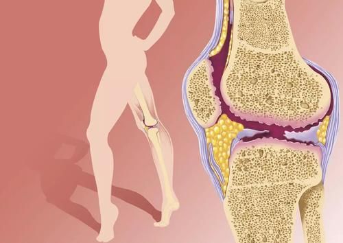 膝关节|上下楼弯腿时膝盖痛是什么原因，如何摆脱疼痛？请看此文