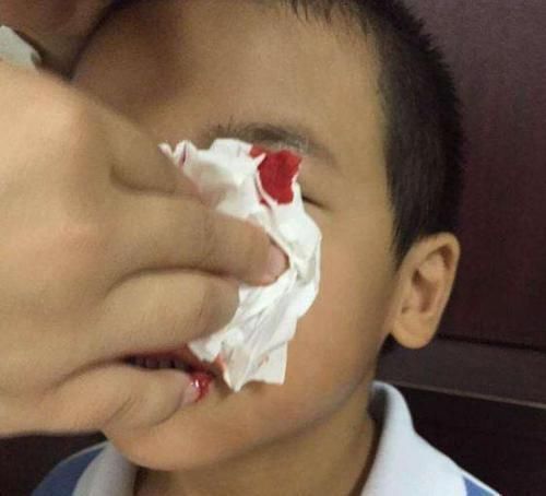 宝妈|3岁男孩摔倒流鼻血,宝妈错误的处理后,医生也“无力回天”