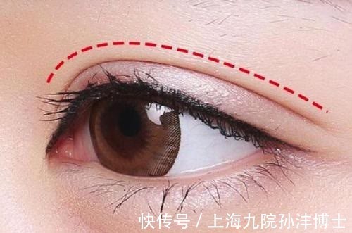 双眼皮 眼修复孙沣博士:双眼皮术后出现分叉能修复吗?