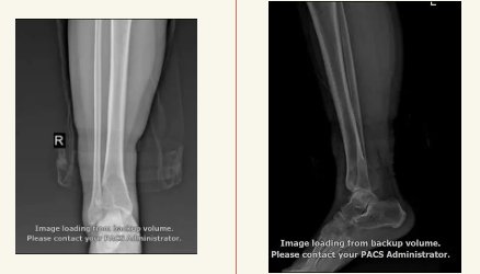 踝关节重建术|姑娘右脚踝疼痛竟是骨肿瘤 医生妙手完成踝关节重建术