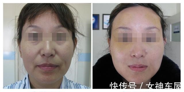 面部 46岁做拉皮手术是种什么体验,分享一下我的真实经历!