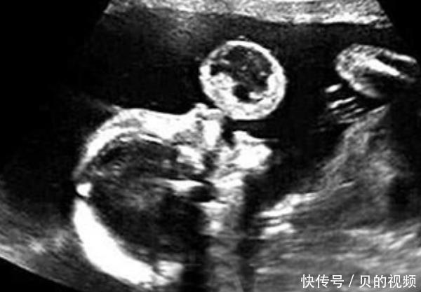 怀孕期间|怀孕后,为何有人一直吐,有人却从不吐医生和腹中胎儿有关