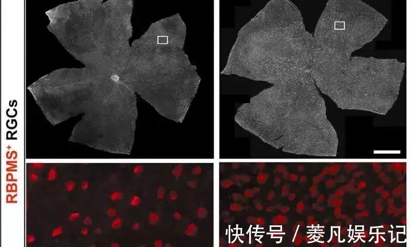 黄斑变性|10年糖尿病,眼睛快看不见了,生酮饮食几个月就好