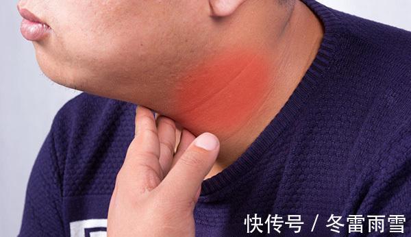 甲减|坚持每天“喝牛奶”,对甲减患者有什么影响文中给出答案