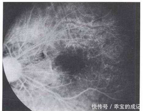 玻璃膜|近视超过600+?我建议你看看自己的眼底,绝对惊恐!