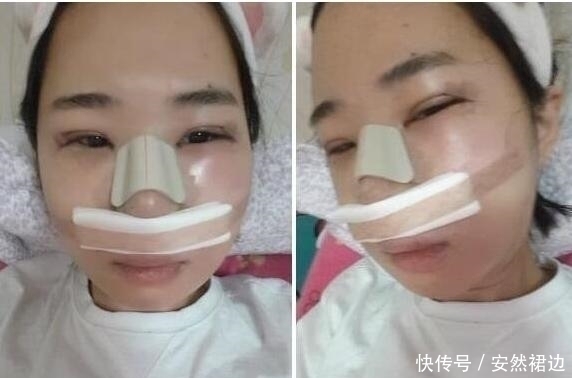 疼痛|小脸确实更可爱,看完整容过程,只觉得满屏的疼痛