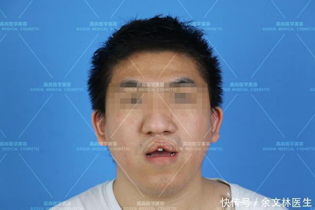 容貌|【案例分享】中年男子也在意相貌?唇裂男子为改善容貌做唇红修复手术