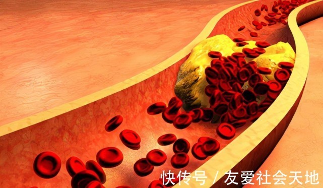 习惯|警惕“沉默杀手”高血脂!3个习惯要趁早改掉,小心血管“水泄不通”