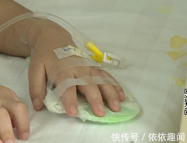 癫痫|4岁女童头上的胎记,一查竟是血管瘤,医生给出了答案