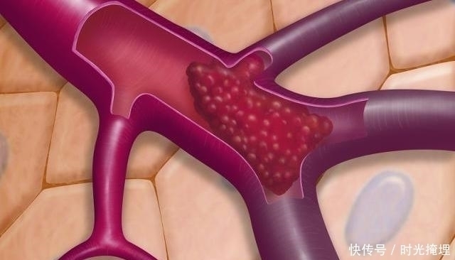 血管堵塞|每天坚持吃几粒,或许助你“清肠化栓”,血栓也不会靠近你