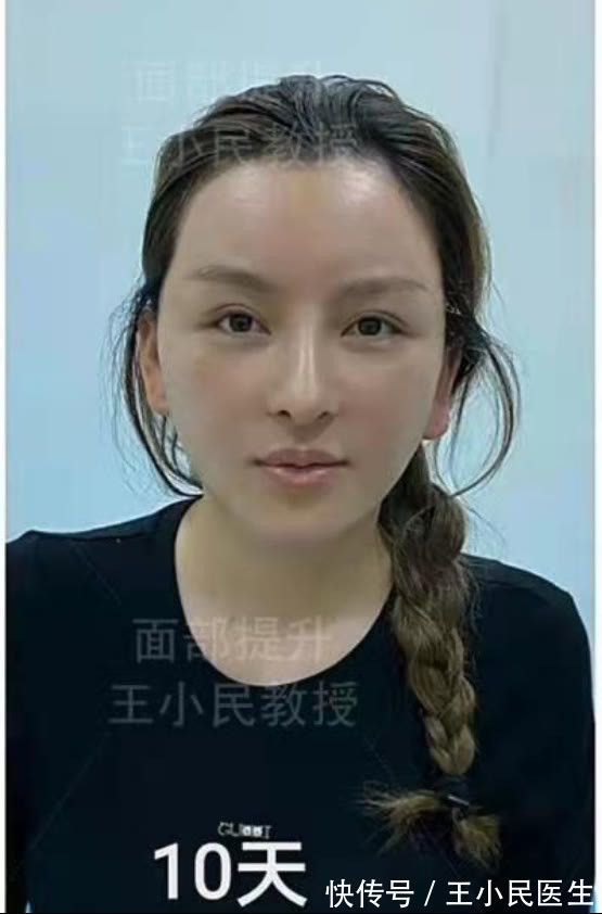 教授 拉皮除皱王小民教授:32岁做小拉皮,变化有多大?