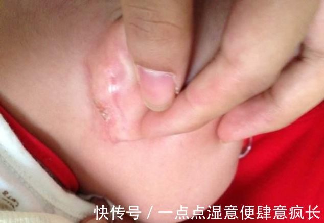 孩子|孩子耳朵旁边长出“聪明孔”,奶奶好奇挤了一下,不料却惹了麻烦