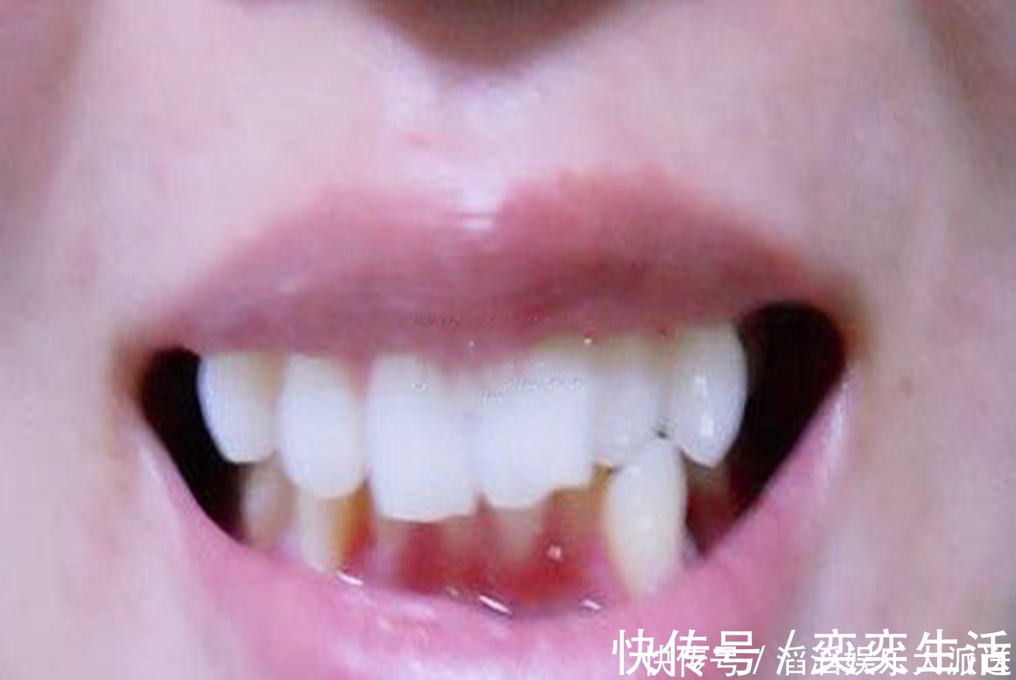 孩子|好不容易等到宝宝换牙期,新牙却长歪了医生家长无知惹得锅