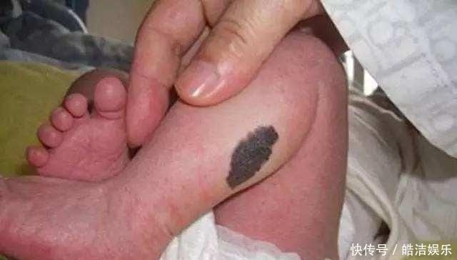 胎记|怀孕时,孕妈若想让宝宝远离胎记,在这4件事上可得长点心了