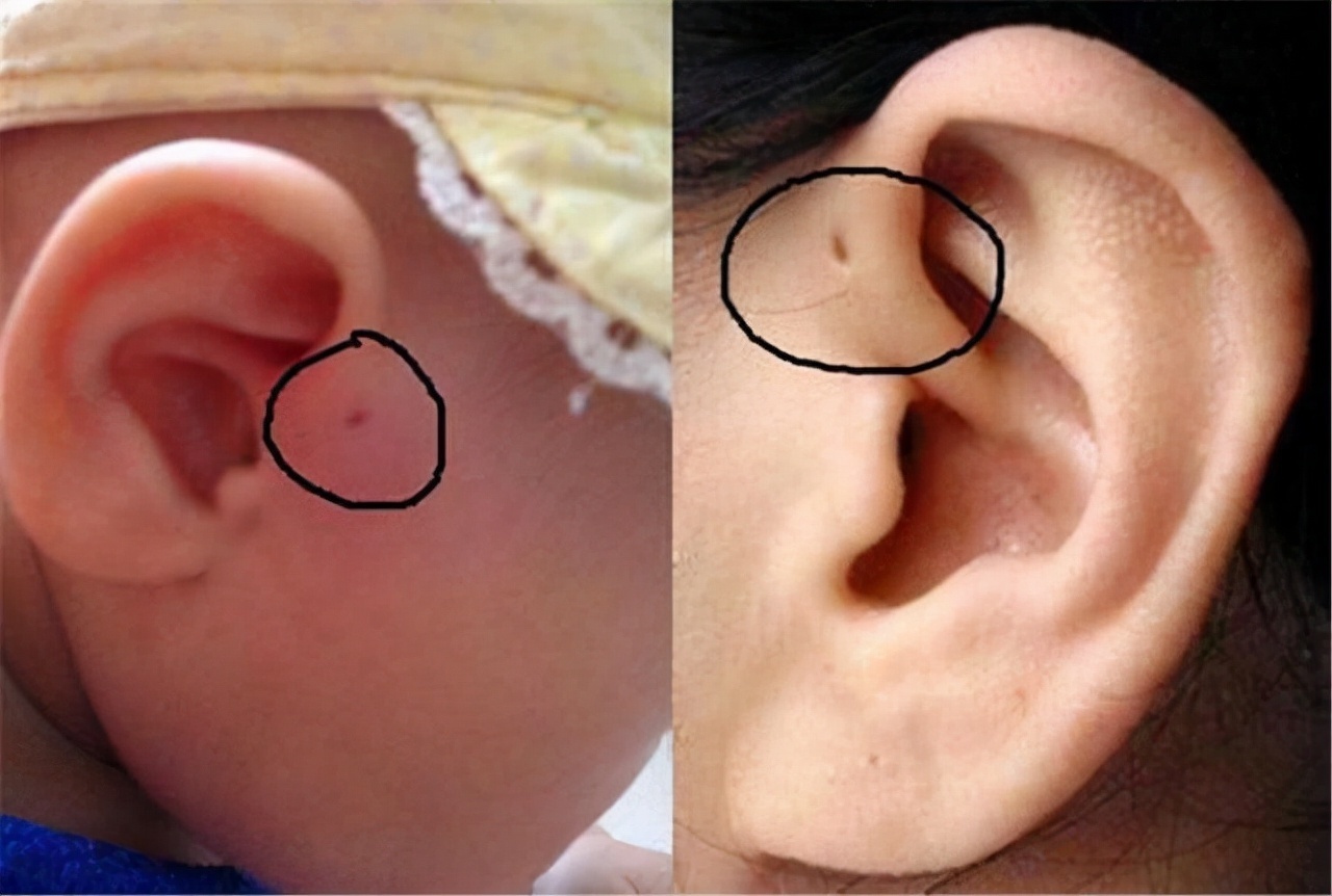 发炎|娃耳朵上的“小孔”是聪明洞医生通常不会明说，妈妈要心知肚明
