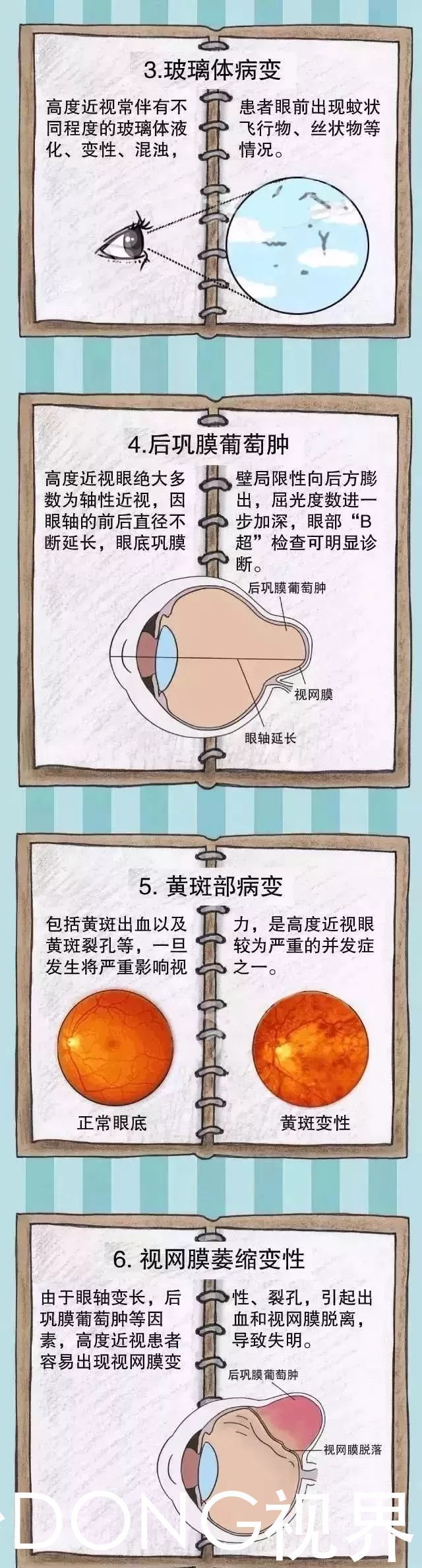 真性近视|高度近视的世界，就是这么残酷。如何预防听听专家怎么说！