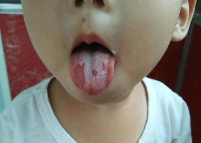 舌苔|儿科医生告诫2件事堪称宝宝脾胃杀手,很多家长在做,简直坑娃