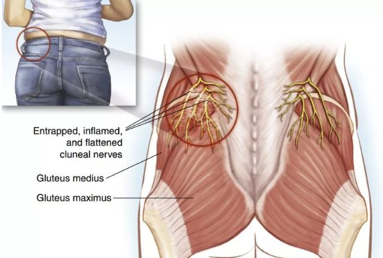 无菌性|腰腿疼痛？可能是臀上皮神经卡压在“作怪”！如何缓解看这里→
