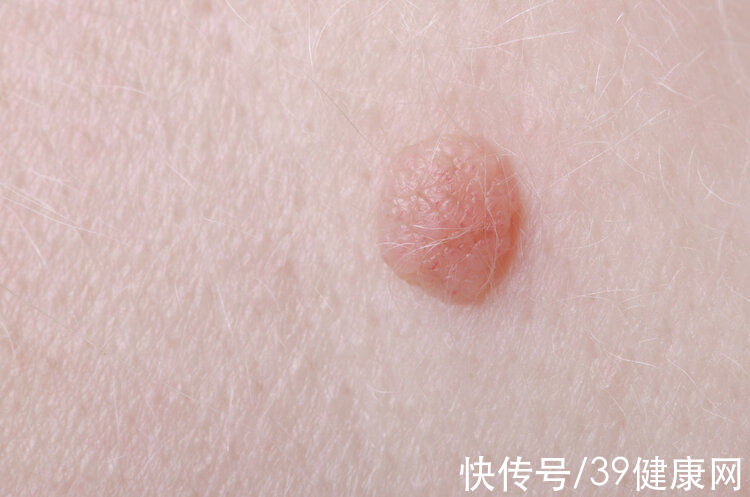 癌变|皮肤上的小肉球、小肉疙瘩是什么？别忽视，小心是感染了HPV