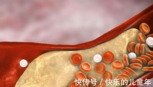 心脑血管疾病|血脂疫苗或许正式启用,每年只需注射2次,适合哪类人打呢?