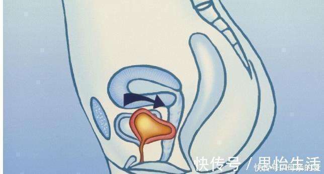 痔疮|屁股出现3大症状,痔疮需要治疗了!试试6招,帮你解决痔疮问题