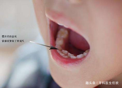 牙齿|孩子乳牙滞留，形成“双排牙”应该怎么办