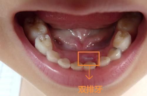 男孩|7岁男孩长出“双排牙”,要一颗一颗拔掉,奶奶自责不已,赖我啊