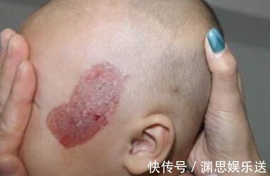 胎儿|女性怀孕后,几件事孕妇最好不要干,要不然出生的婴儿可能有胎记