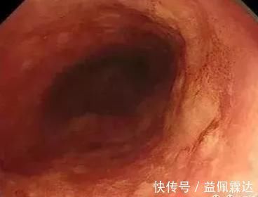 胸骨|明明是慢性咽炎,胃镜查出食管癌!医生忠告:出现这些症状别大意