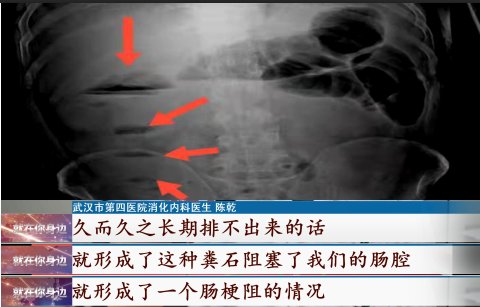 肠梗阻|武汉七旬老人为了解决便秘，每天喝这种“油”，结果…医生提醒…