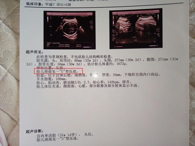 宝宝|孕晚期,避免胎儿脐带绕颈?你需要注意这些