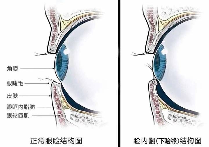 睑内翻|「护眼小科普」眼睑内翻是怎么回事？