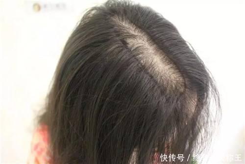 雄激素|李时珍每天泡“1物”,1周改善脱发,肾脏变强,头发乌黑亮丽