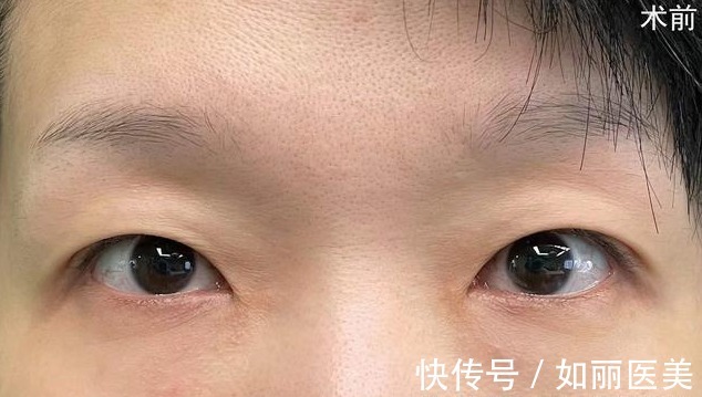 切口 双眼皮越宽眼睛就越大吗？医生揭开双眼皮手术的5个“真相”！