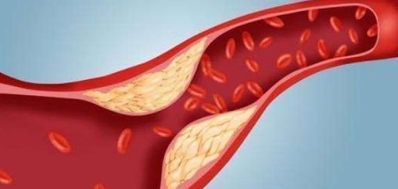 预防糖尿病|喝茶有益于预防糖尿病,但你真的喝对了吗?了解下,喝出好血糖