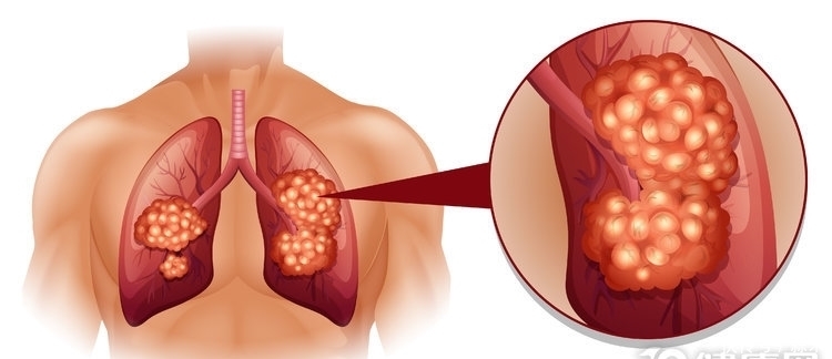 因素|肺癌晚期不治疗,能活多长时间?有3个决定因素