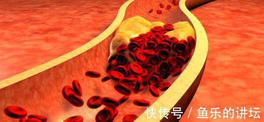 冠状动脉|心血管专家：这“3点”是冠心病的真凶！只要少1条，健康加1倍