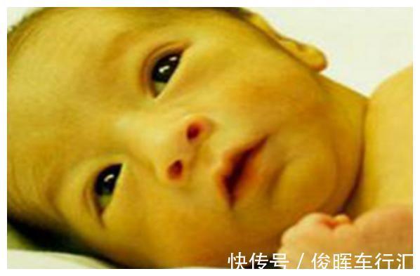 病理性黄疸|儿科医生:想要宝宝出生没黄疸,孕期坚持“3不做”,别不当回事