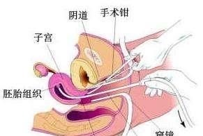 火葬场|人流后的胎儿去哪了,3种处理方式,每一种都让人心疼