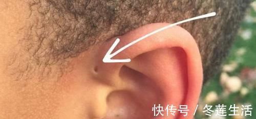 宝妈|宝宝耳朵有“聪明孔”,妈妈忍不住挤了一下,医生摇头动手术吧