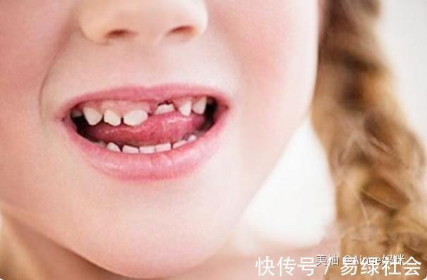 乳牙|孩子乳牙整齐漂亮,换牙后却越来越“歪”可能是这几点没做好