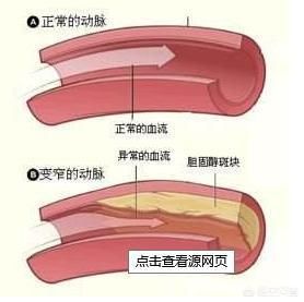 为什么经常跑步锻炼的人也会有冠状动脉狭窄？